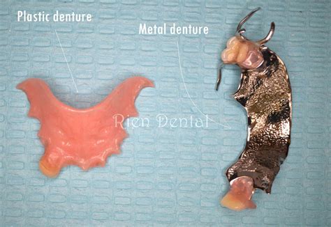 metal housing denture|metal vs plastic partial dentures.